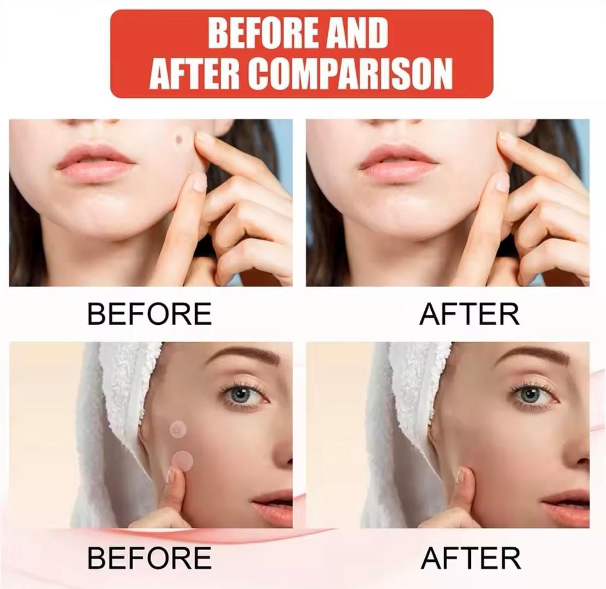 PARCHE INVISIBLE PARA EL ACNE DE 24PZA - Imagen 4